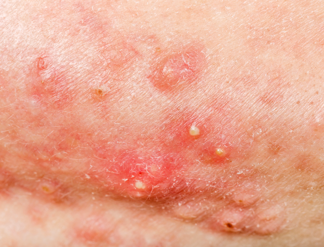 Body Acne, Congestion & Breakouts on the Back and Chest