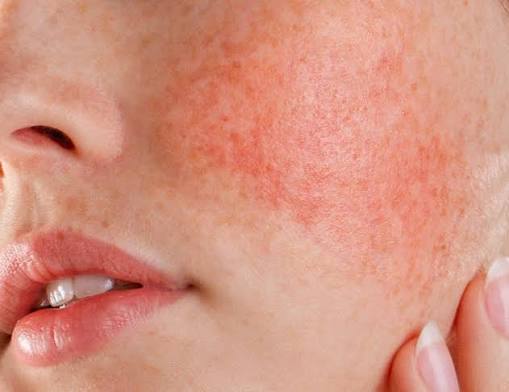 Redness & Sensitivity