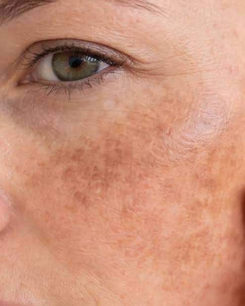 Pigmentation & Uneven Skin Tone