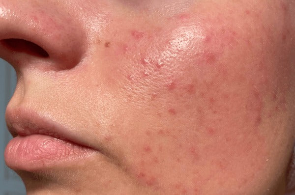 Acne & Breakouts