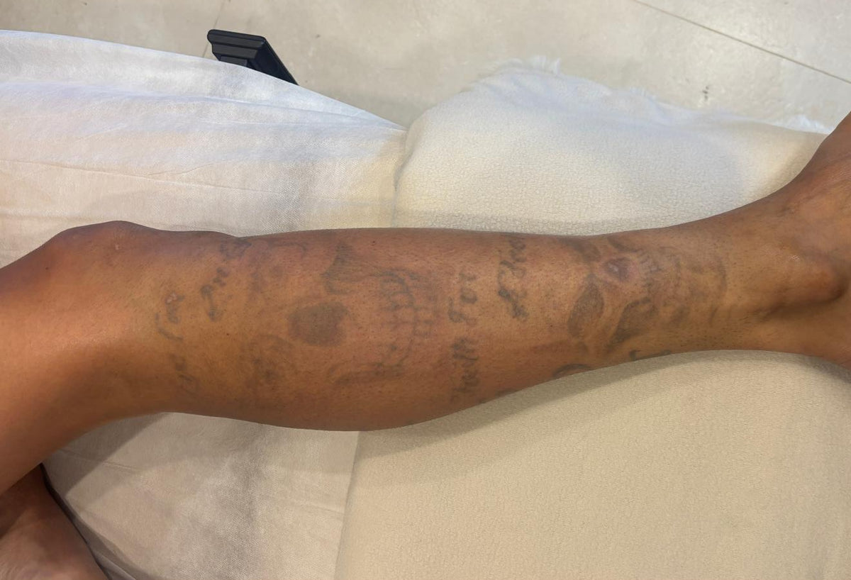 Large leg tattoo fading after Pico laser tattoo removal at Kalani Clinic, near Bankstown 