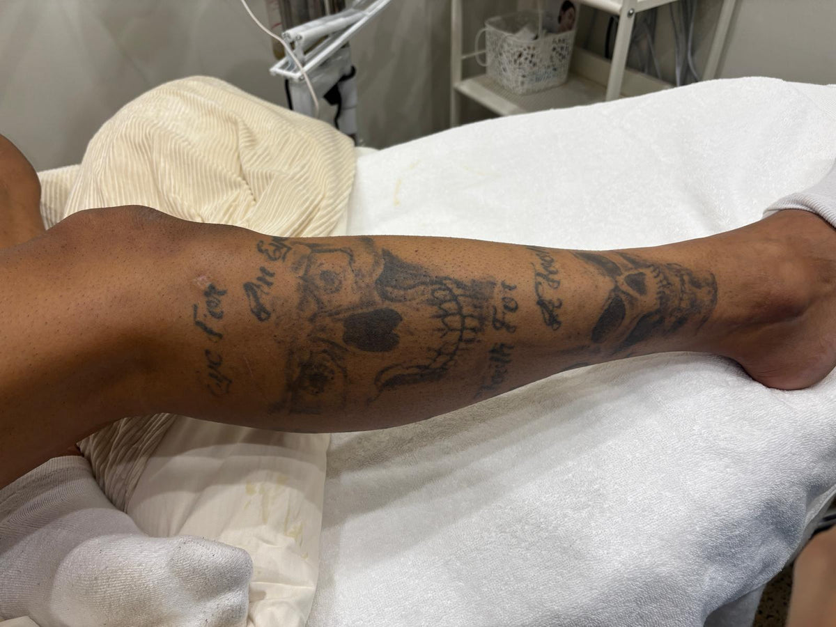 Large leg tattoo before Pico laser tattoo removal treatment at Kalani Clinic in Western Sydney