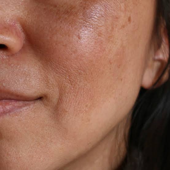 Woman with patchy facial pigmentation illustrating the appearance of melasma