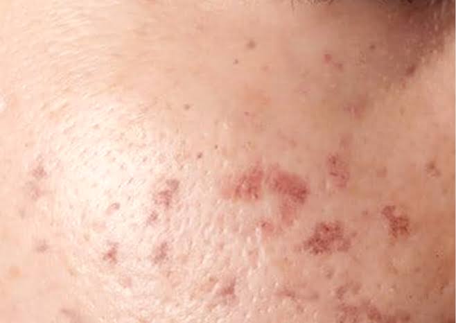 Close-up illustrating dark post-acne marks and uneven skin tone