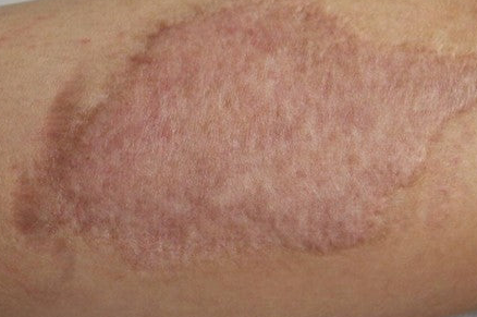 Close-up illustrating an area of post-inflammatory skin pigmentation