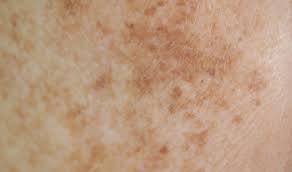 pigmentation.jpg