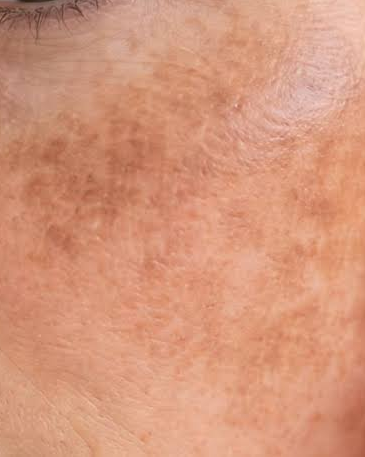 Close-up illustrating sun-related facial pigmentation and uneven skin tone